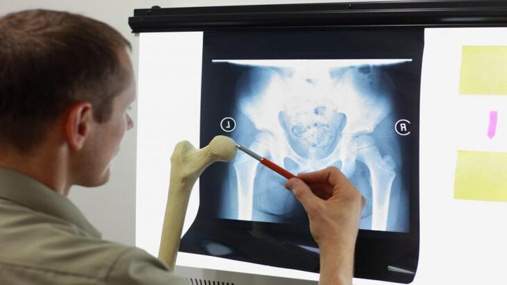 The doctor examines an x-ray to detect osteoarthritis of the hip.