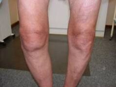Symptoms of osteoarthritis of the knee joint.